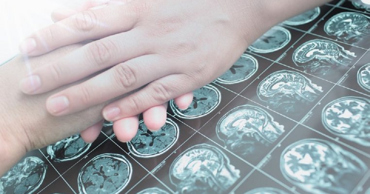 Tumorile cerebrale, principala cauză oncologică de deces din România