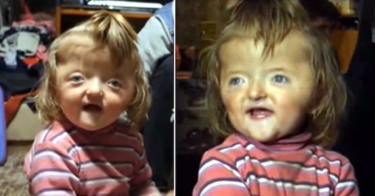 O fetiță de 2 ani nu a fost primită la creșă pe motiv ca înfățișarea ei sperie copiii