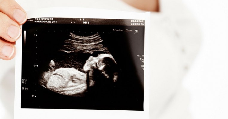O fetiță s-a născut gravidă și a fost necesară o operație de cezariană chiar în a doua zi de viață