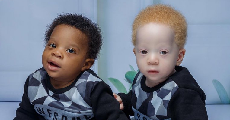 viziunea albinismului