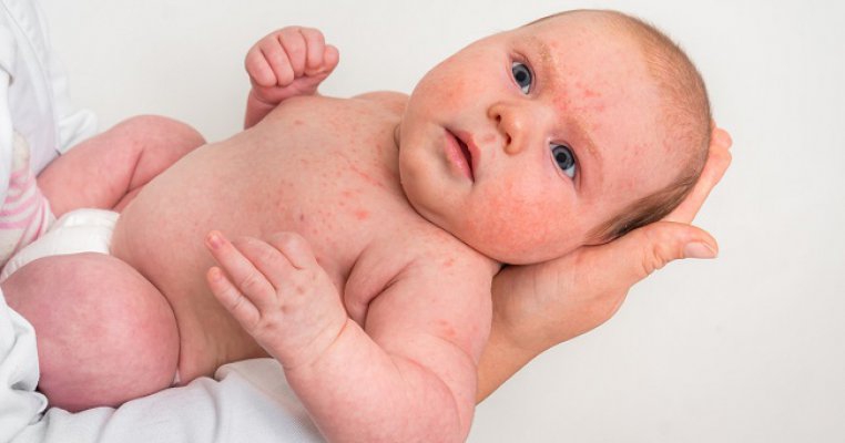 Alergia la bebeluși: cauze, simptome, tratament