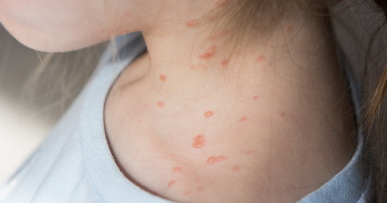 Variola maimuței se extinde în Europa. Ce este și de ce se introduce carantina pentru pacienții infectați