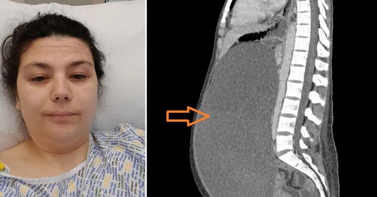Medicii i-au spus că e doar surplus de grăsime, dar această mamă era să moară din cauza unei boli nediagnosticate!