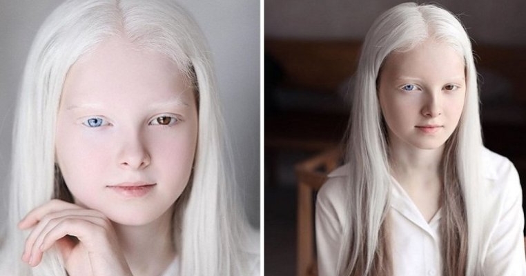 Are 11 ani, suferă de albinism și este una dintre cele mai frumoase fetițe din lume!