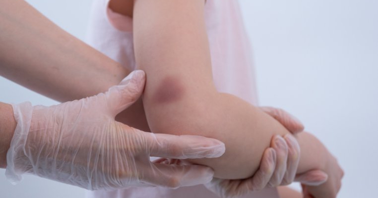 O fetiță de trei ani, plină de vânătăi pe corp, a primit un diagnostic extrem de grav. Mama ei credea că se lovește la joacă