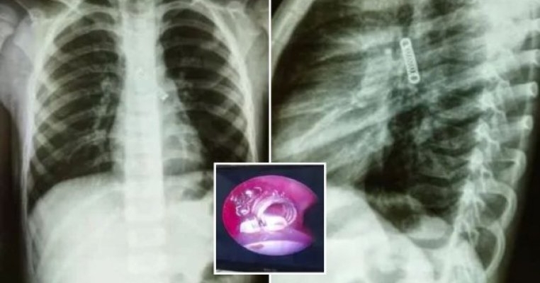 Un băiețel de cinci ani a tușit timp de trei luni, fără să aibă alte simptome. Ce obiect i-au descoperit medicii în plămâni
