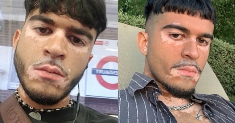 Nu am nevoie de niciun tratament care să mă vindece de vitiligo. Este superputerea mea!