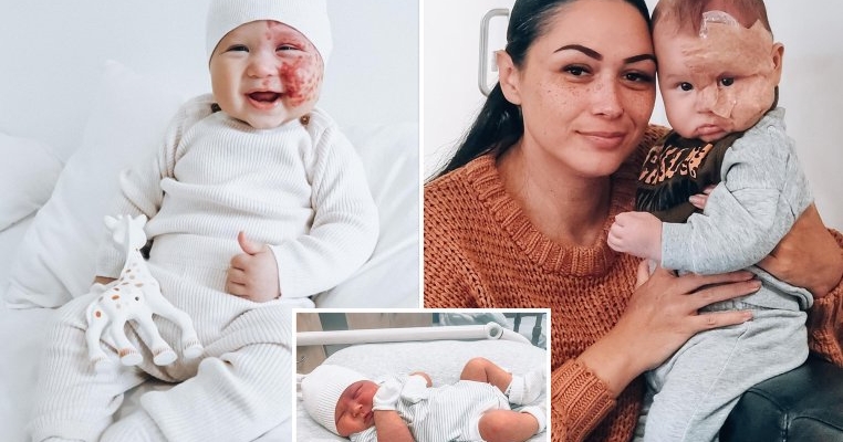 O mamă a decis să opereze cu laser semnul din naștere facial al copilului ei și internauții o consideră un monstru
