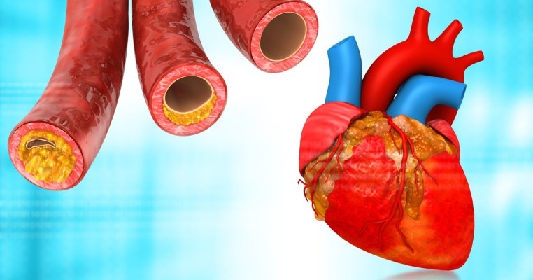 Ulcer varicos: cauze, simptome și tratament