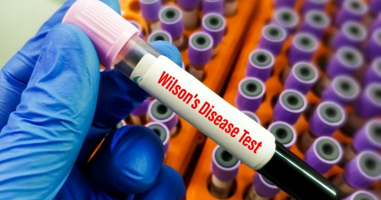 Boala Wilson: cauze, simptome și tratament