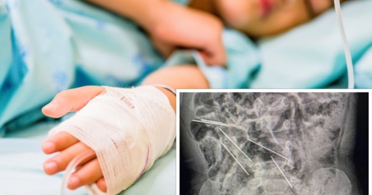 Un copil de 2 ani a înghițit 8 ace, dar mama lui nu a observat, pentru că era ocupată cu munca