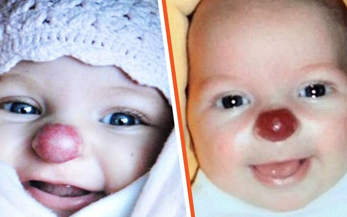 Fetița "Rudolf", care a venit pe lume cu nasul roșu, a devenit o adolescentă superbă! Transformarea este uluitoare