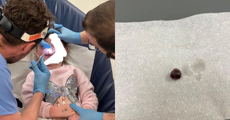 Mare grijă la obiectele mici, când vine vorba despre copii. O fetiță a fost bolnavă timp de 3 luni de la o stafidă blocată în nas