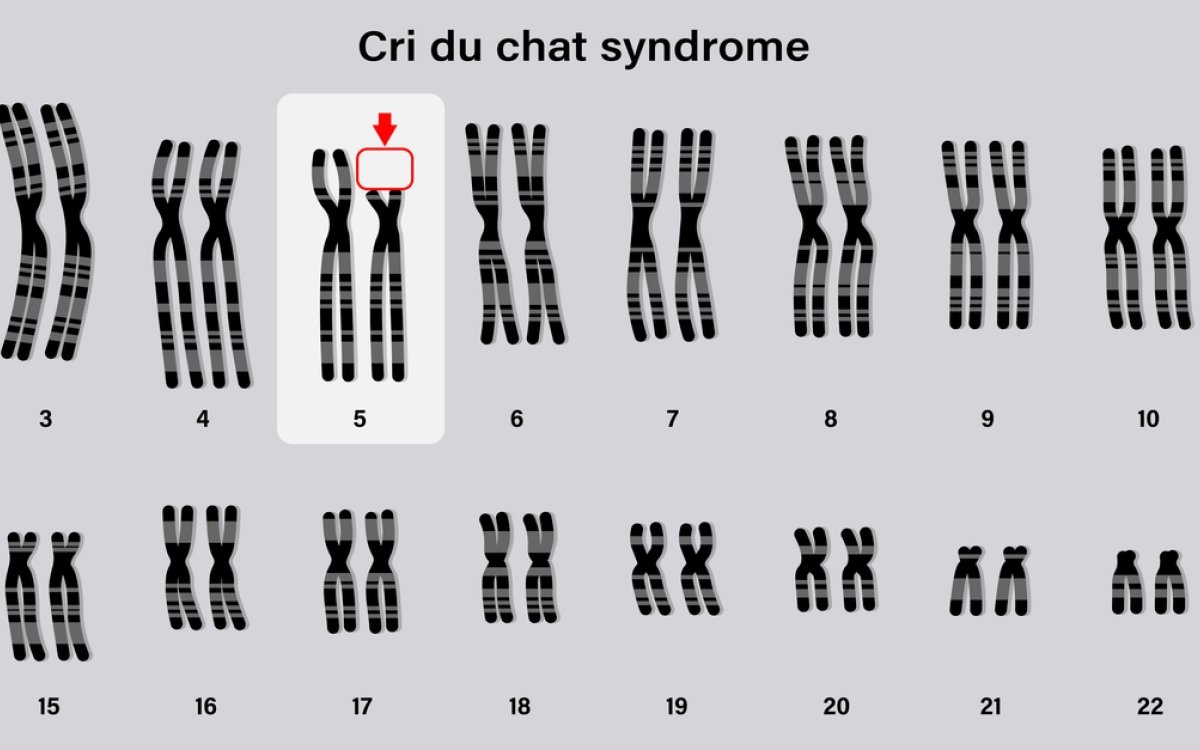 Sindromul Cri du chat: cauze, simptome si tratament