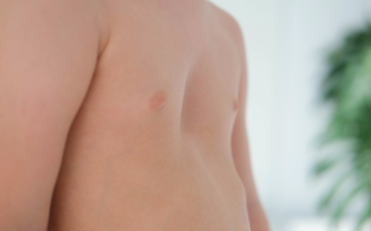 Pectus excavatum: cauze, simptome și tratament