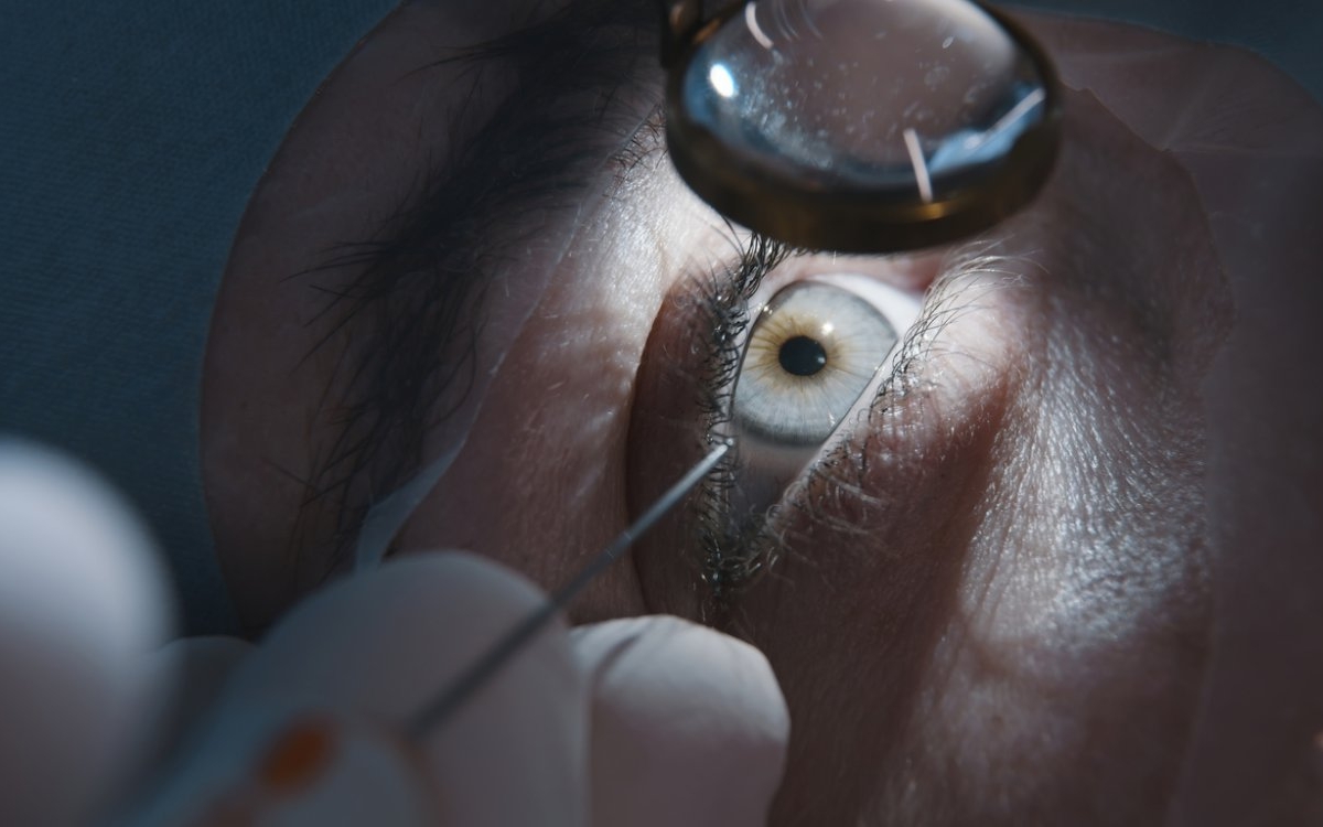 Chist dermoid orbital: cauze, simptome și tratament
