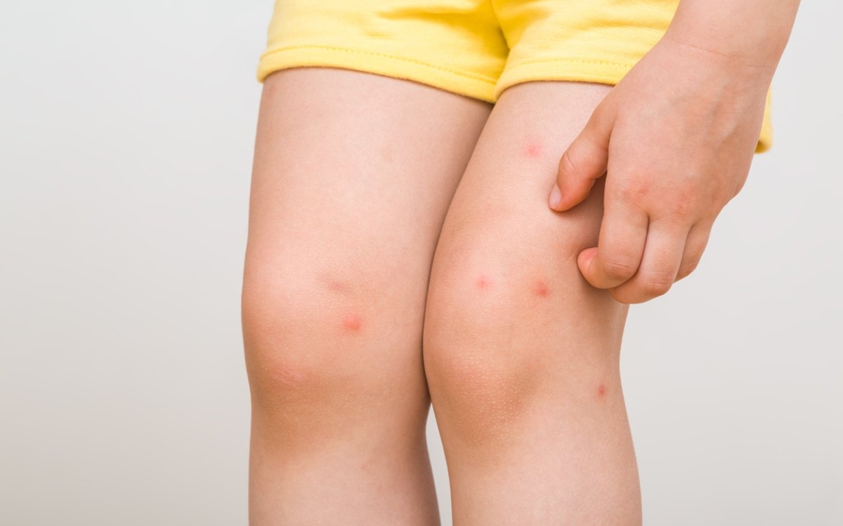 Mușcătura de furnică la copii: simptome și tratament