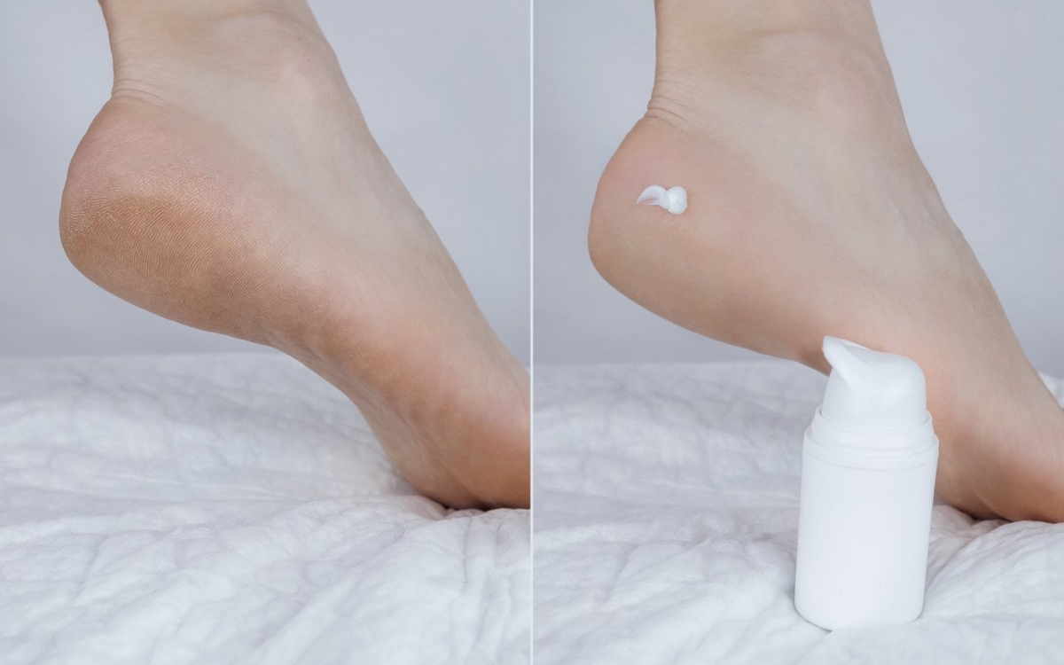 Crema cu uree: beneficii pentru piele