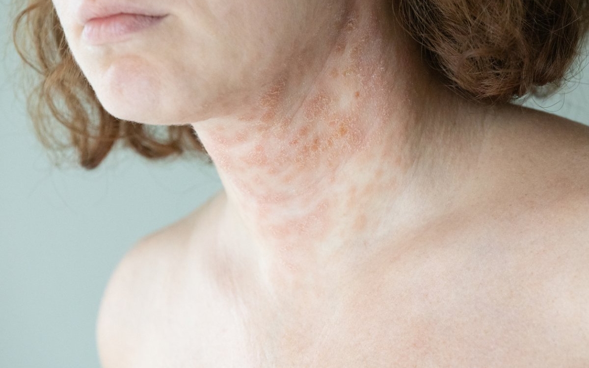 Dermatita exfoliativă: cauze, simptome și tratament