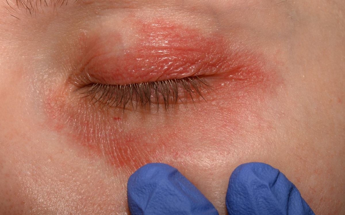 Sindromul Netherton: cauze, simptome și tratament