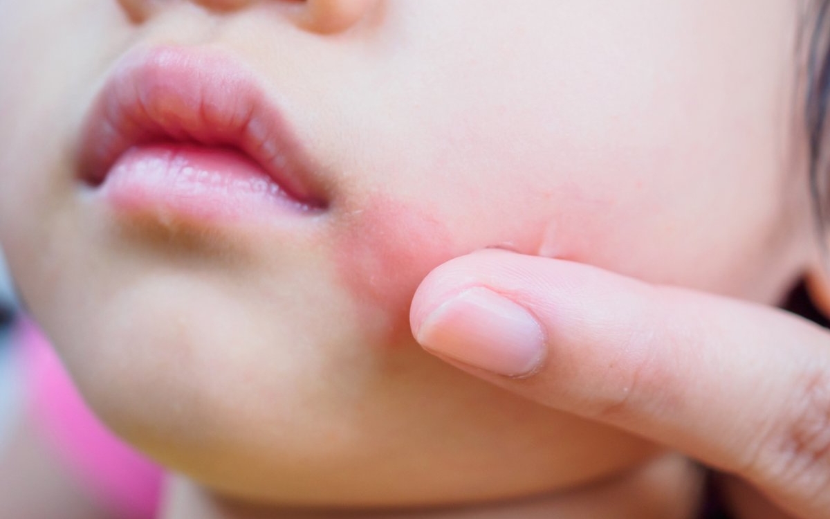 Boala obrajilor pălmuiți: cauze, simptome și tratament