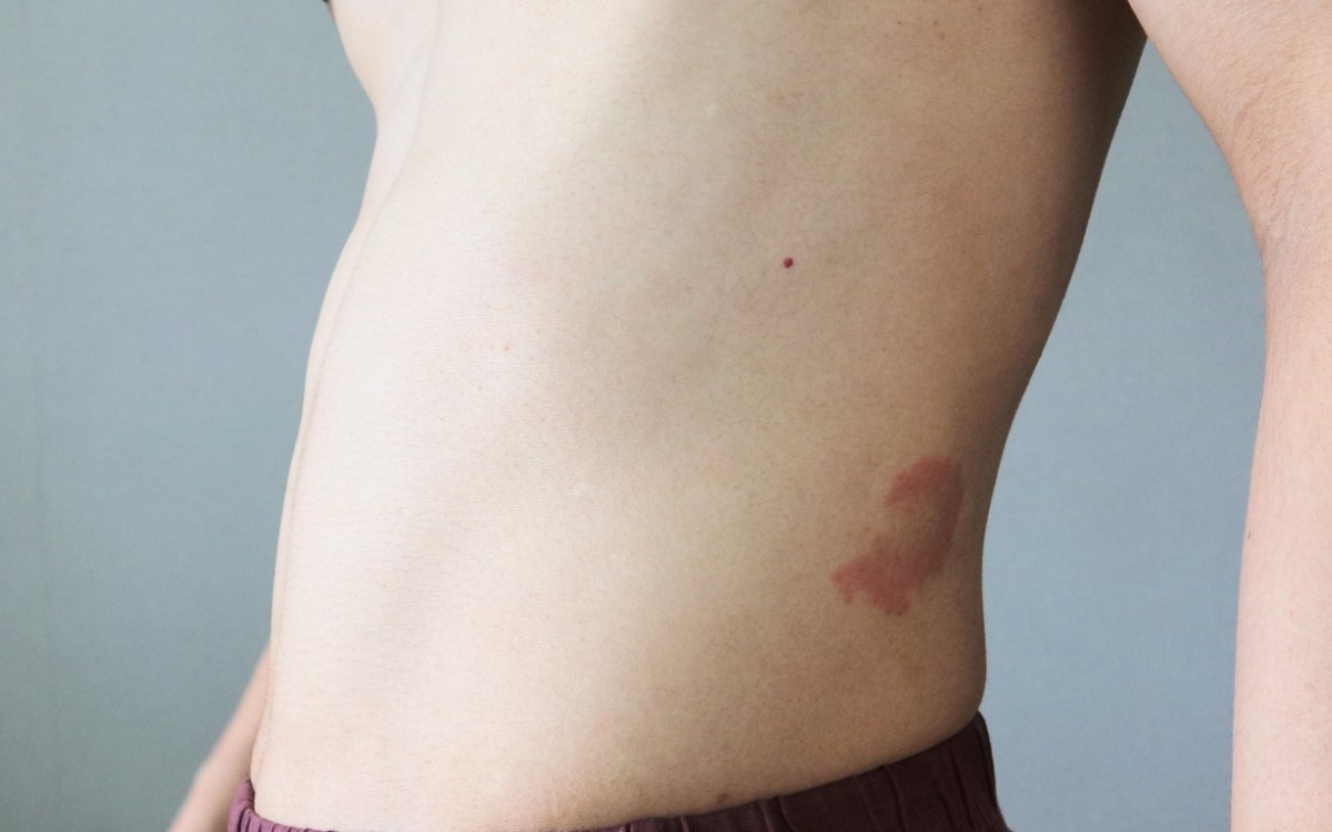 Sindrom Maffucci: cauze, simptome și tratament