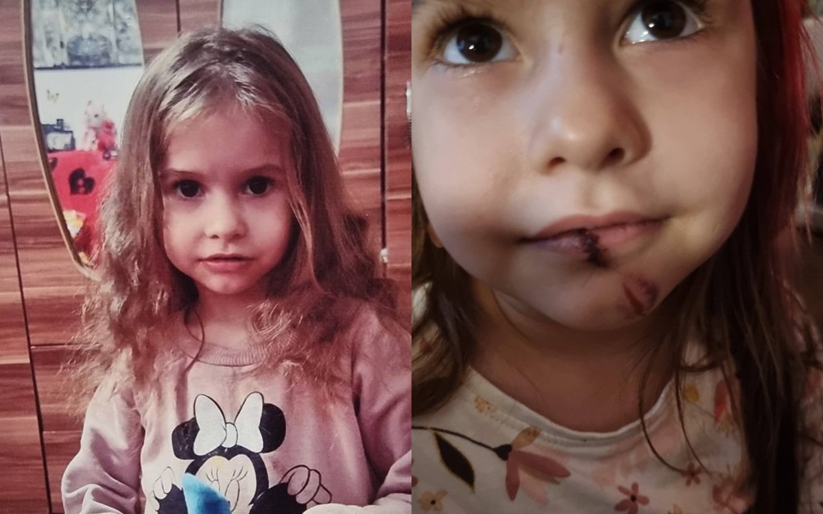 "Fetița mea desfigurată și cu buza spintecată". Un tată din Ostroveni a fost chemat la gradiniță după ce fetița lui și-ar fi spart buza
