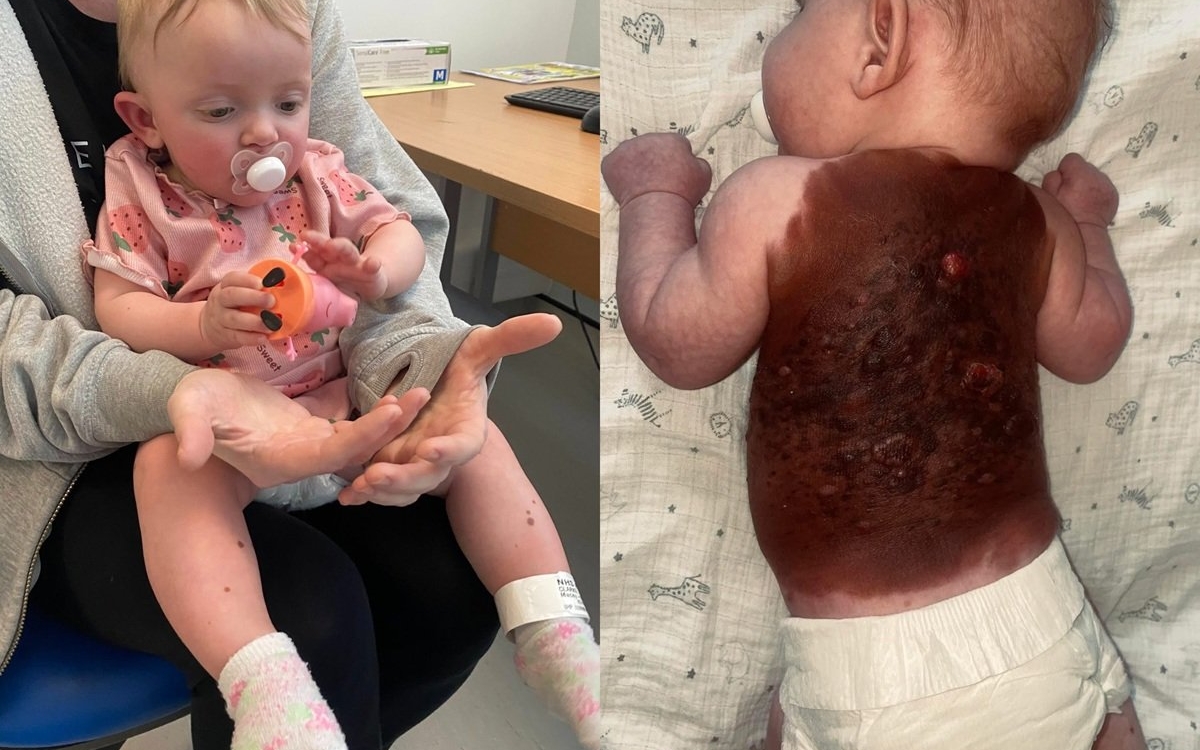 O fetiță s-a născut cu o formă extrem de gravă de nev congenital non-neoplazic, care îi acoperă în totalitate spatele. „E un caz extrem de rar, 1 la un jumătate de milion"