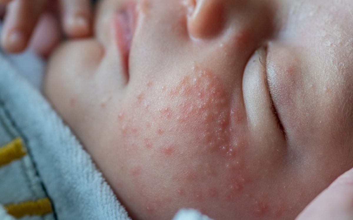 Bebelușul și erupțiile de pe piele. Cum recunoști dermatita de scutec, alergiile sau iritațiile obișnuite