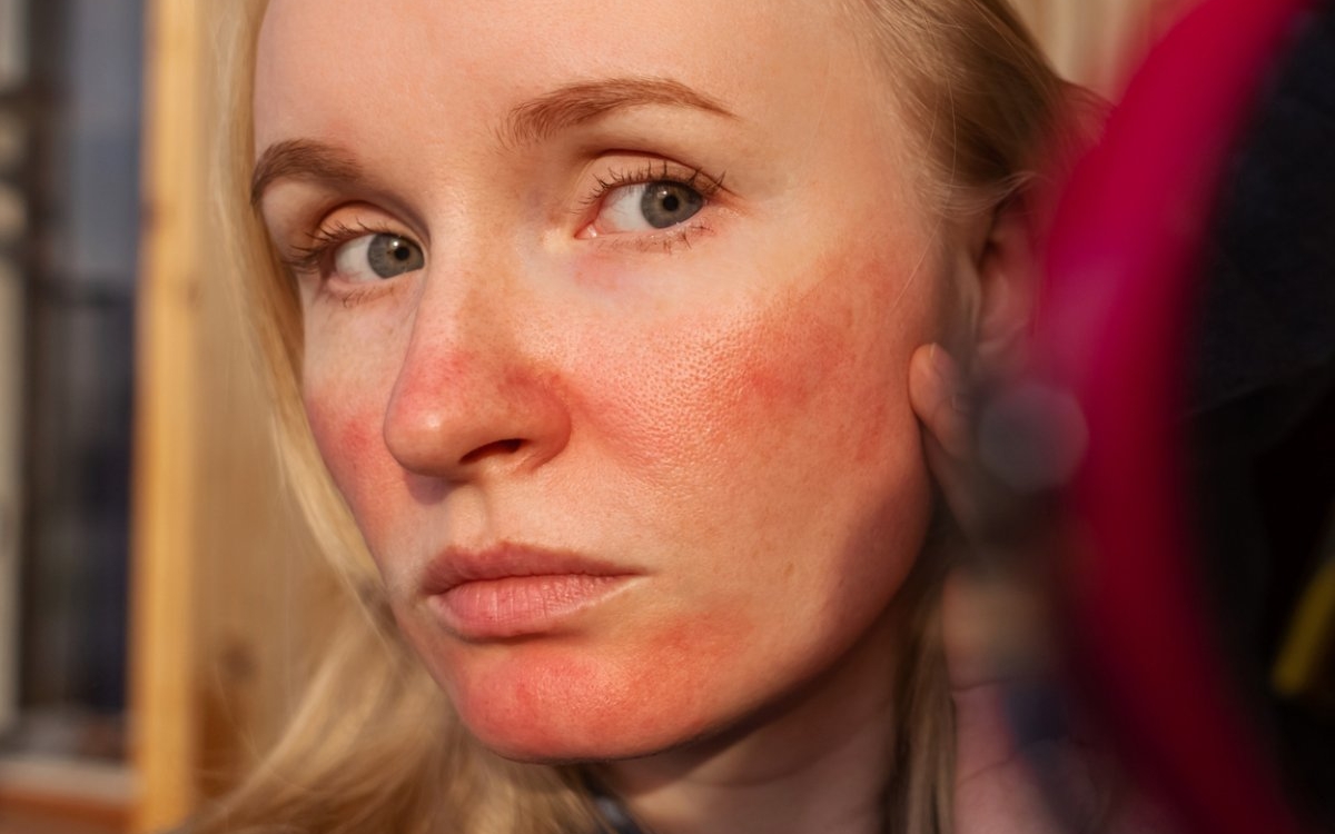 Prurigo actinic: cauze, simptome si tratament