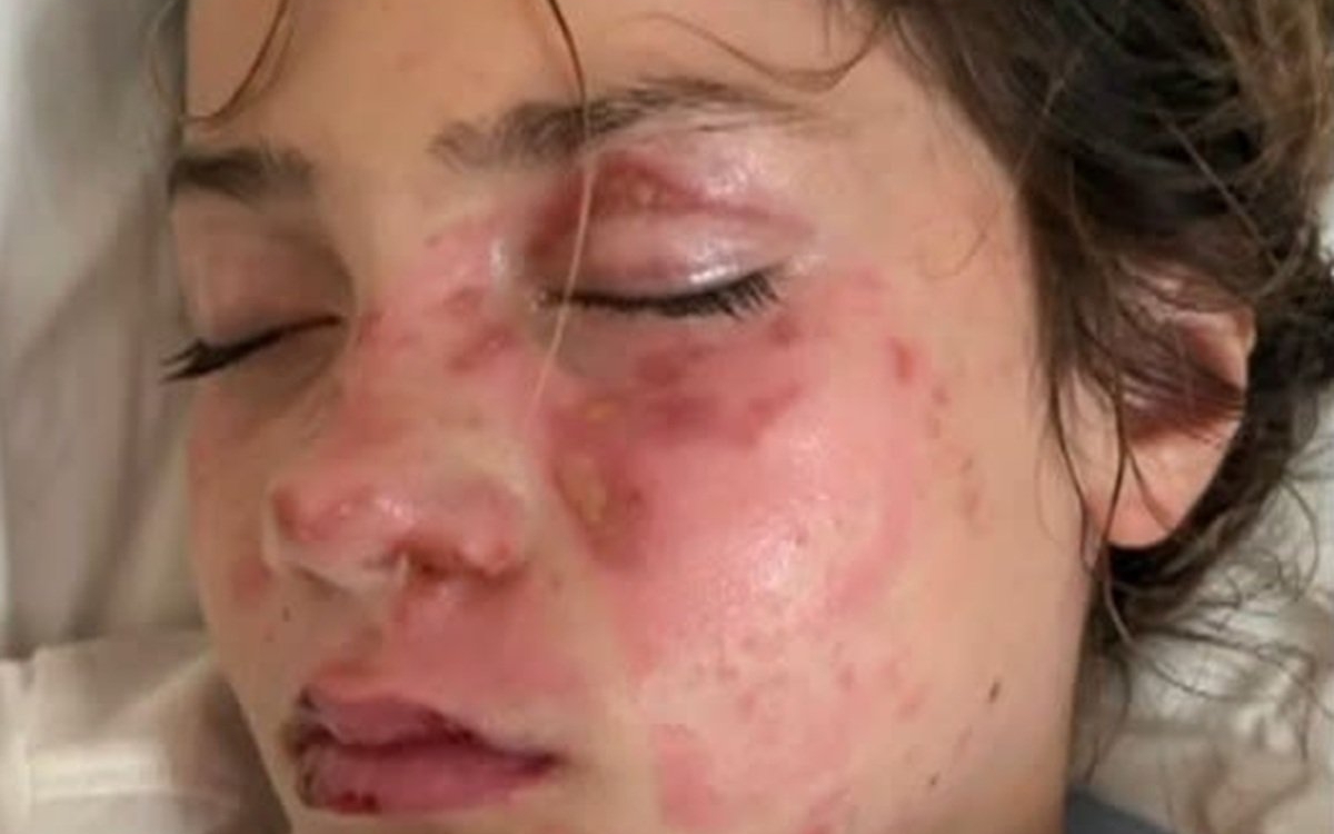 Atenție la trendurile de pe TikTok! O fetiță de 10 ani a suferit arsuri extrem de grave la nivelul feței după ce a pus o jucărie de plastic la microunde