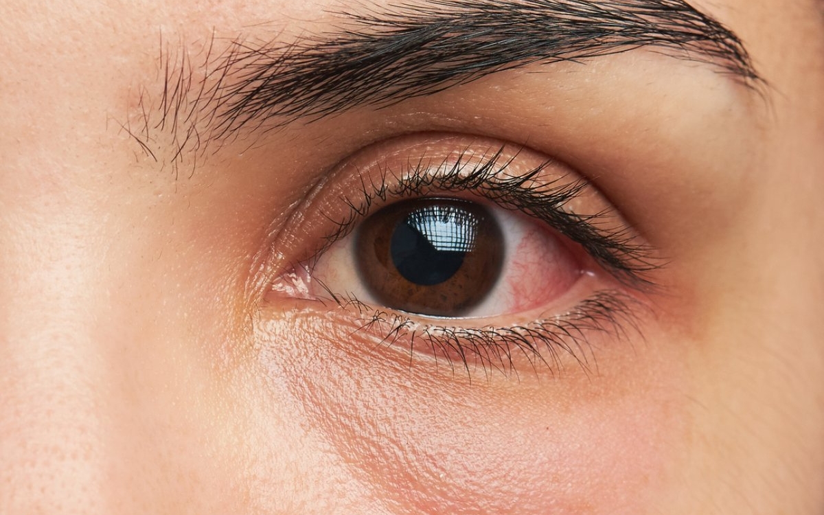 Ocluzia vasculară retiniană: cauze, simptome și tratament