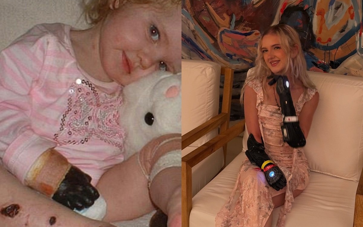 Faceți cunoștintă cu „fata bionică"! Tilly și-a pierdut ambele brațe la 15 luni din cauza septicemiei meningococice, dar și-a transformat dizabilitatea într-o superputere