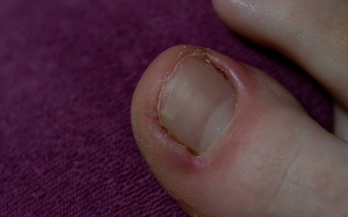 Paronichia: cauze, simptome si tratament