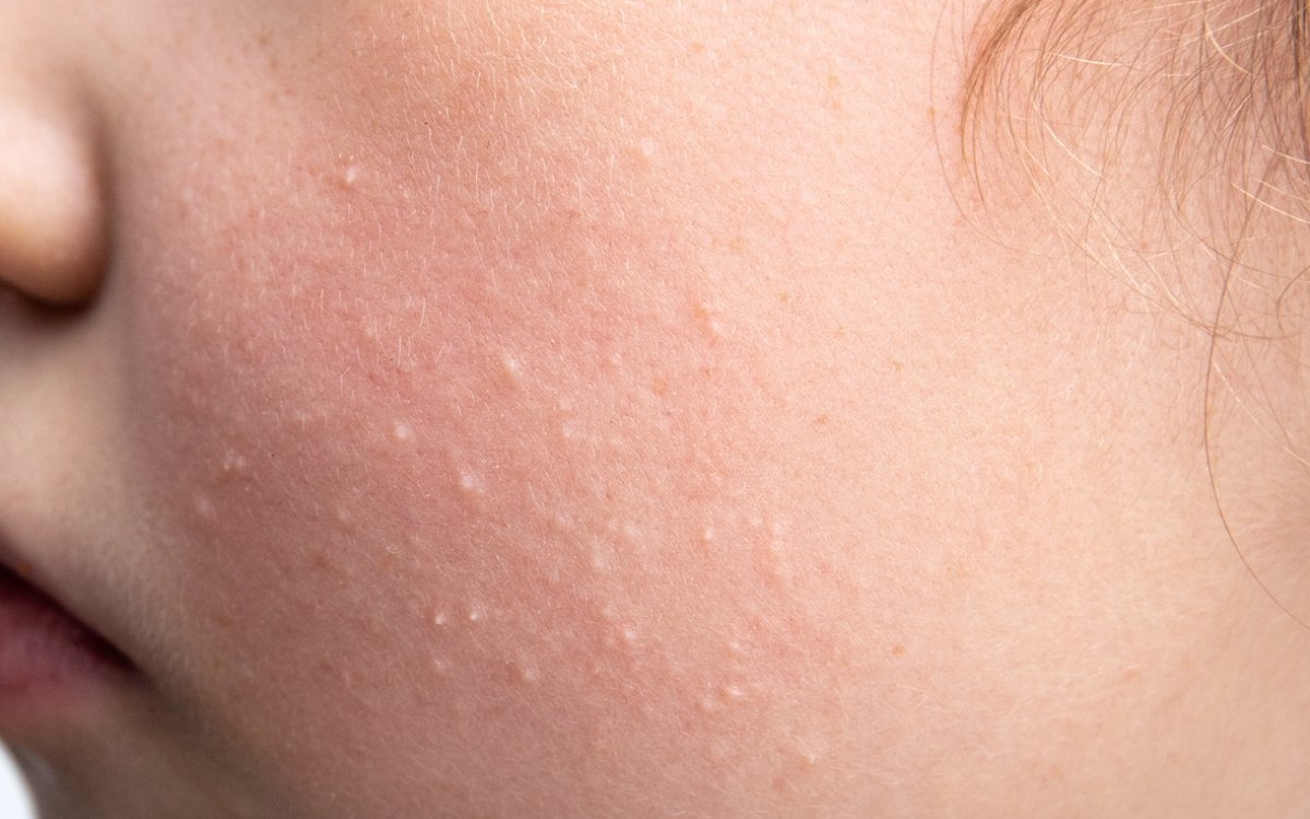 Hiperplazie sebacee: cauze, simptome și tratament
