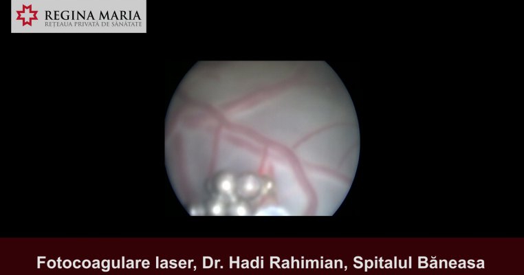 Premiera medicala in Romania, la Spitalul Baneasa: gemeni identici salvati printr-o interventie cu laser efectuata in uterul mamei