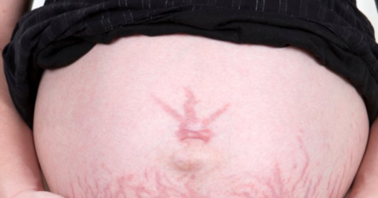Vergeturile: cauze si tratamente naturiste