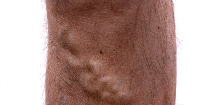 Varice: cauze, simptome, tratamente naturiste