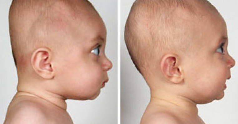 Osul frontal la bebelusi
