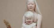 “Multă lume este surprinsă că suntem albino..."