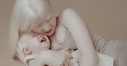 Persoanele cu albinism trebuie să fie atente cu expunerea la soare