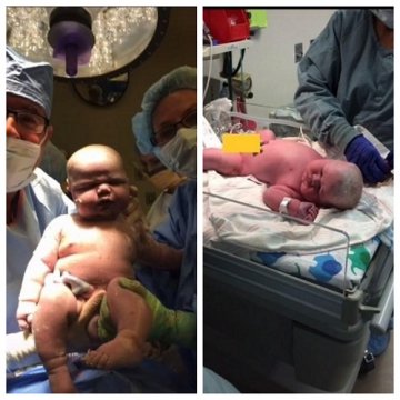 Un bebeluș de 6,3 kg s-a născut prin cezariană