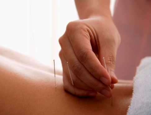 Acupunctura