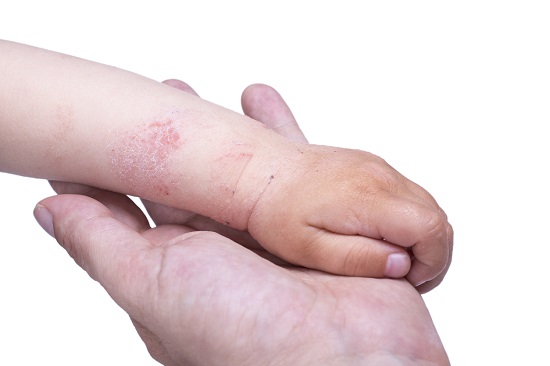 Manuta de copil cu eczema