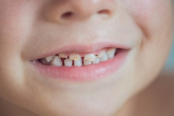 Calciul La Copii Suplimente De Calciu La Copil Qbebe Ro