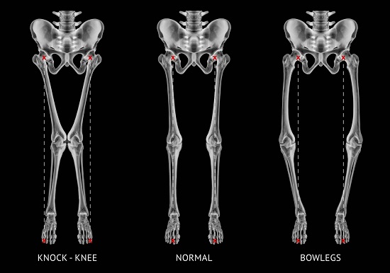 radiografie care arata deformari la nivelul membrelor inferioare