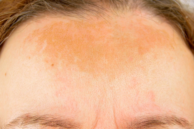 melasma 2