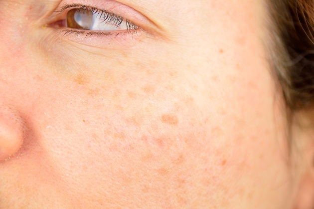 melasma