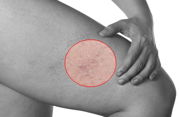 tipuri de tratament varicoză varicoză laser