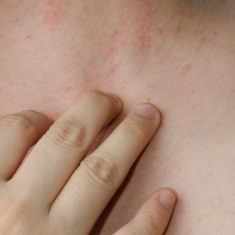 eczema copii